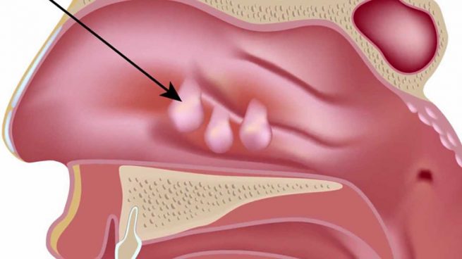 Polyp M I Tr Nguy N Nh N V C Ch I U Tr Thu C D N T C