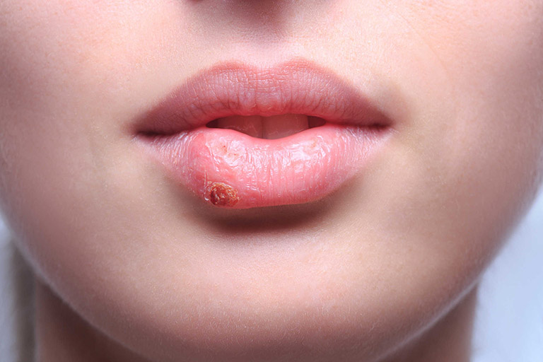 Acrovy điều trị bệnh herpes môi