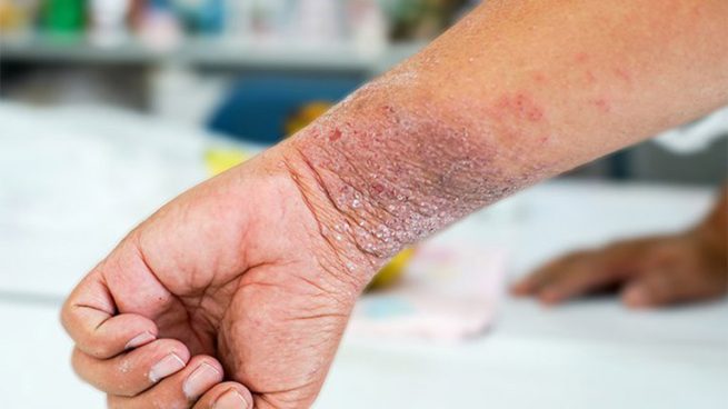 Bệnh chàm khô có lây nhiễm không?