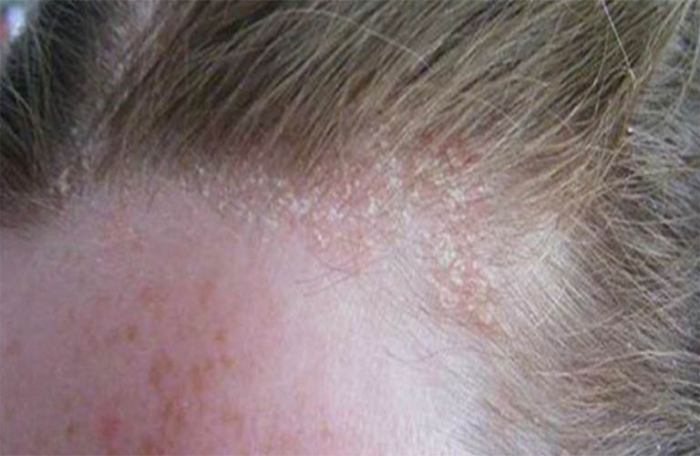 triệu chứng viêm da tiết bã trên da đầu