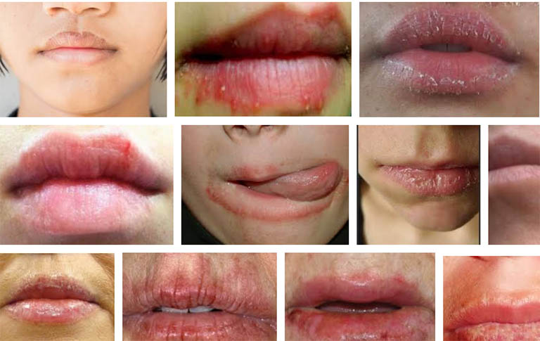 Bị chàm môi có chữa hết được không chữa bằng cách nào