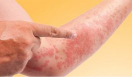 Nổi đốm đỏ trên da nhưng không ngứa có thể là dấu hiệu của nhiều bệnh nguy hiểm