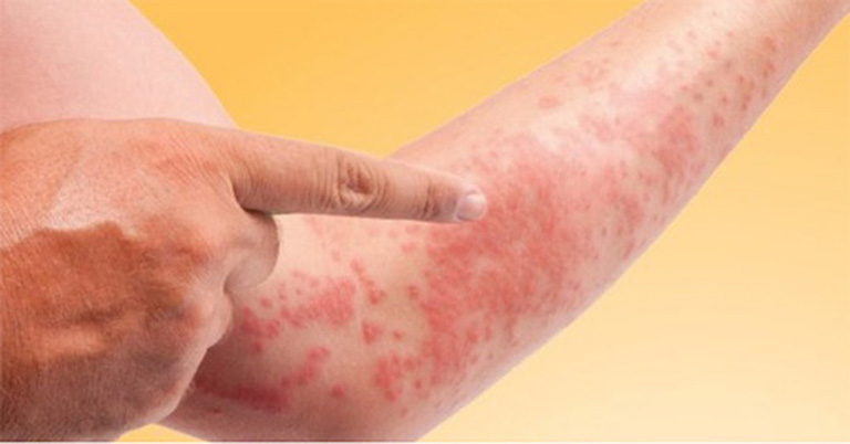 Nổi đốm đỏ trên da nhưng không ngứa có thể là dấu hiệu của nhiều bệnh nguy hiểm