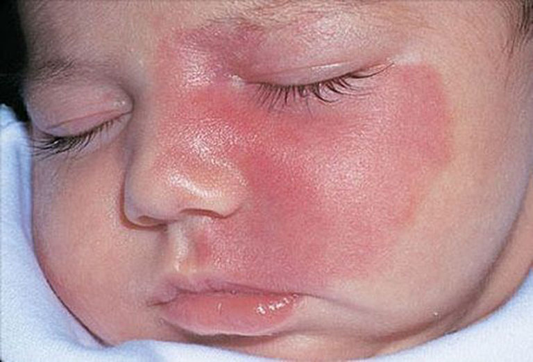 Nổi đốm đỏ trên da nhưng không ngứa có thể là dấu hiệu của bệnh u máu