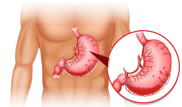 Thủng dạ dày là một trong những biến chứng của bệnh viêm loét dạ dày tá tràng - hậu quả của viêm loét dạ dày tá tràng - biến chứng của thủng ổ loét dạ dày tá tràng 