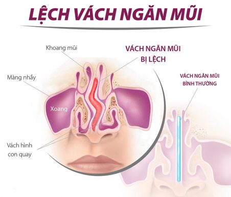 Tìm hiểu về chứng lệch vách ngăn mũi và cách điều trị