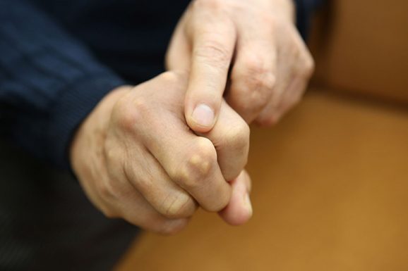 Nhiễm trùng hạt tophi