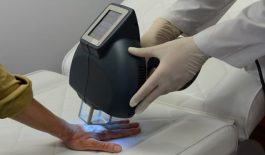 Tìm hiểu phương pháp điều trị vẩy nến bằng tia laser Excimer