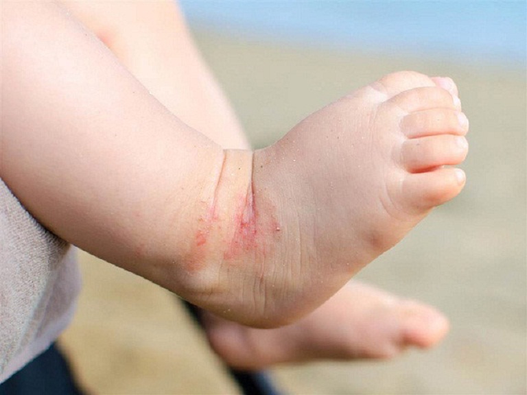 Viêm da cơ địa khiến trẻ nổi mẩn ngứa ở tay và chân