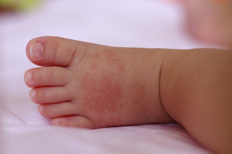 Trẻ nổi mẩn ngứa ở tay và chân vì bị chàm di truyền