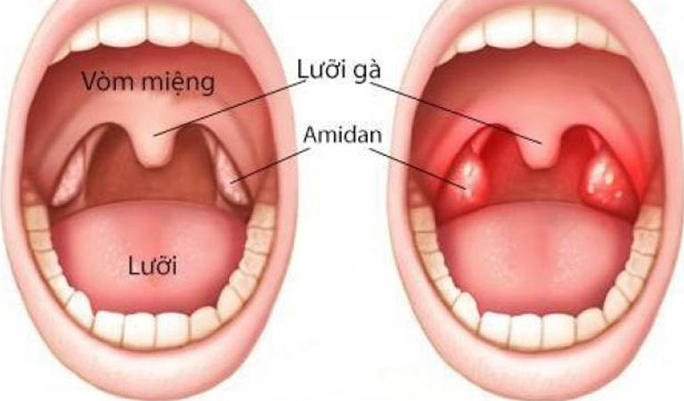 Viêm amidan: Nguyên nhân, triệu chứng và cách điều trị