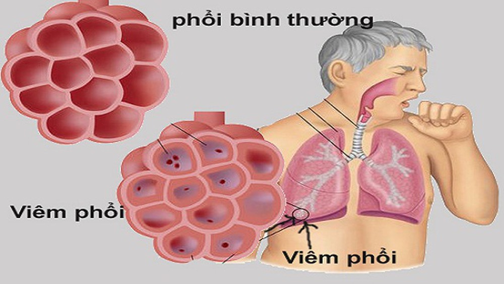 nguyên nhân viêm phổi