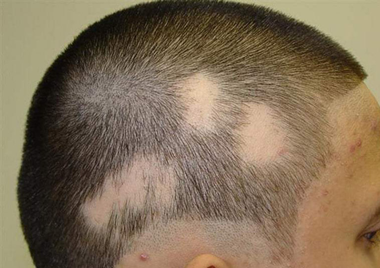 Hiện tượng rụng tóc từng mảng có đáng lo ngại không?
