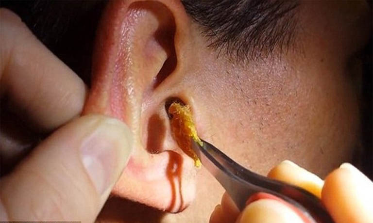 cách làm sạch ráy tai