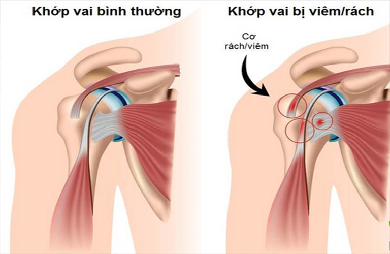 đau khớp vai khi chơi cầu lông