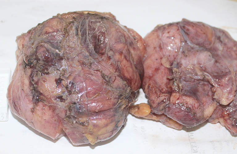 khối u mỡ trong niêm mạc dạ dày