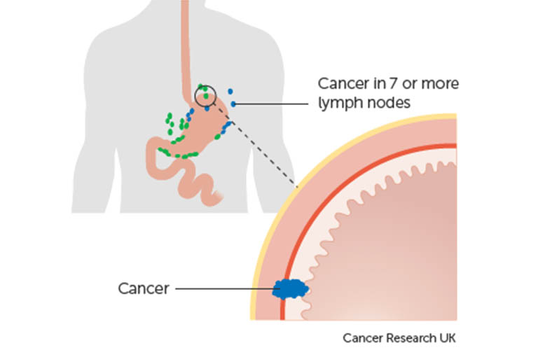 ung thư dạ dày giai đoạn 3