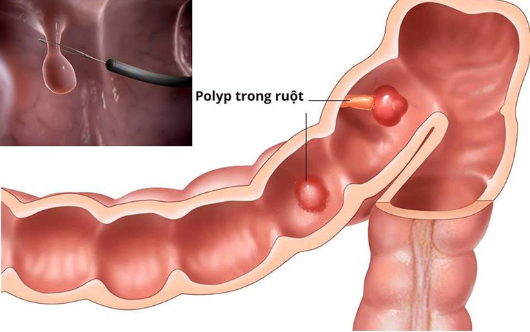 polyp trực tràng lành tính polyp đại tràng bệnh học polyp trực tràng và đại tràng polyp đại tràng ngang u polyp đại tràng polyp trực tràng và kết tràng polyp trực tràng và cách điều trị polyp đại tràng tuyến ống polyp trực tràng bệnh học