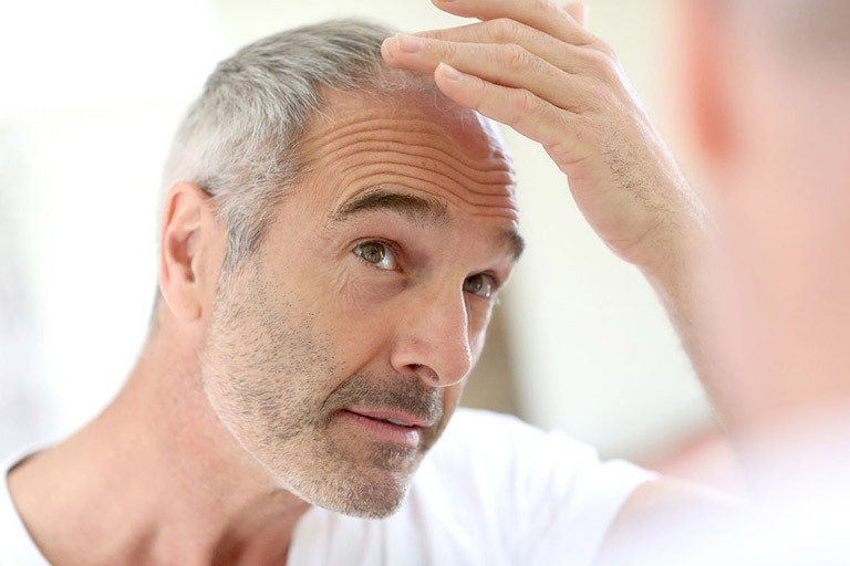 3 Dấu hiệu của chứng hói đầu ở nam giới và cách khắc phục