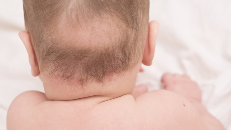 rụng tóc ở trẻ sơ sinh