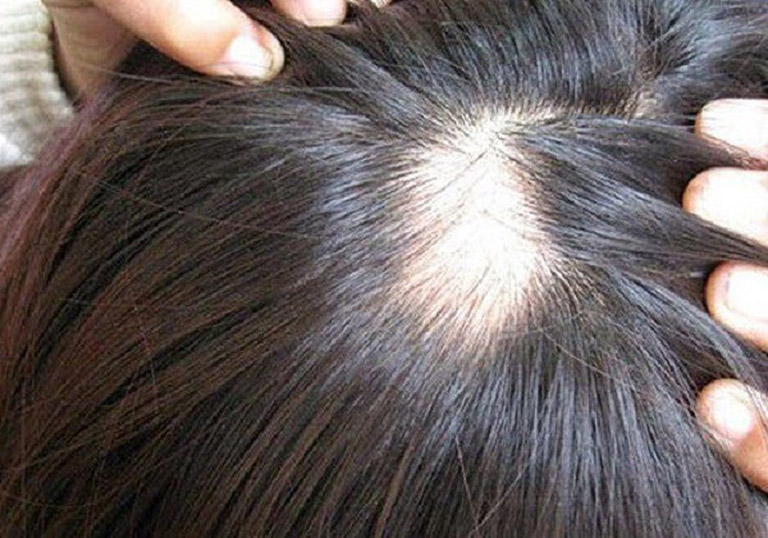 nguyên nhân và triệu chứng rụng tóc từng mảng