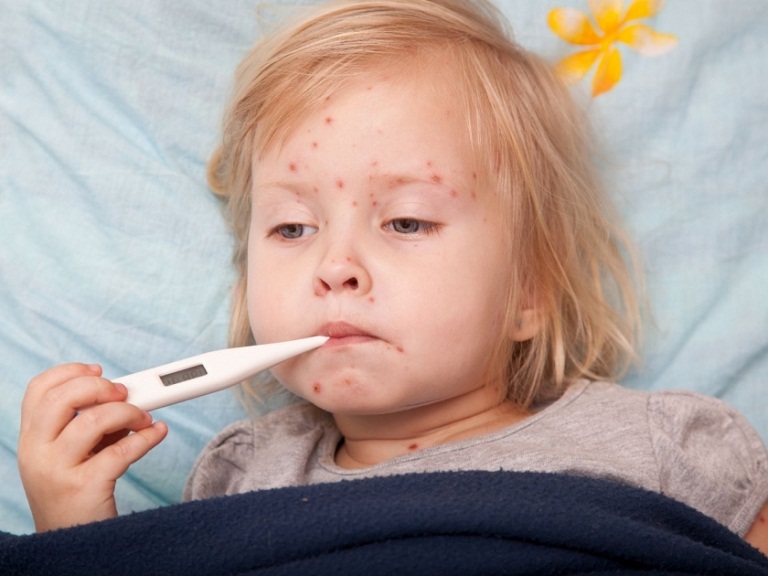 Trẻ bị sốt phát ban