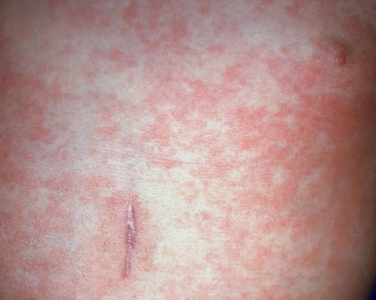 Sốt cao kèm với phát ban da màu hồng hoặc hồng nhạt là biểu hiện đặc trưng của bệnh sốt phát ban