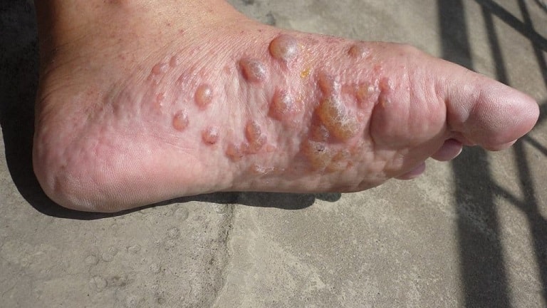 Bệnh tổ đỉa ở bàn chân