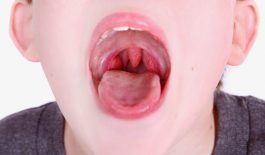 bệnh viêm họng liên cầu khuẩn