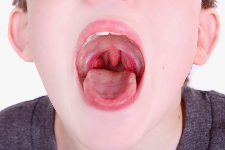 bệnh viêm họng liên cầu khuẩn