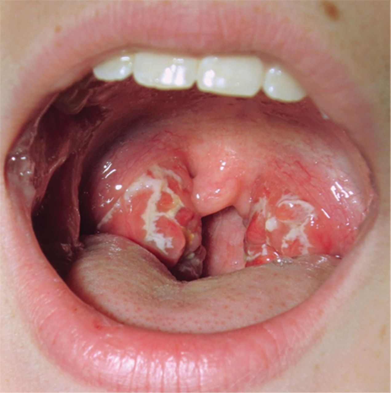 triệu chứng viêm loét họng 