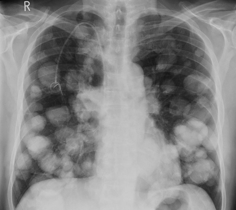ung thư đại tràng di căn phổi sống được bao lâu