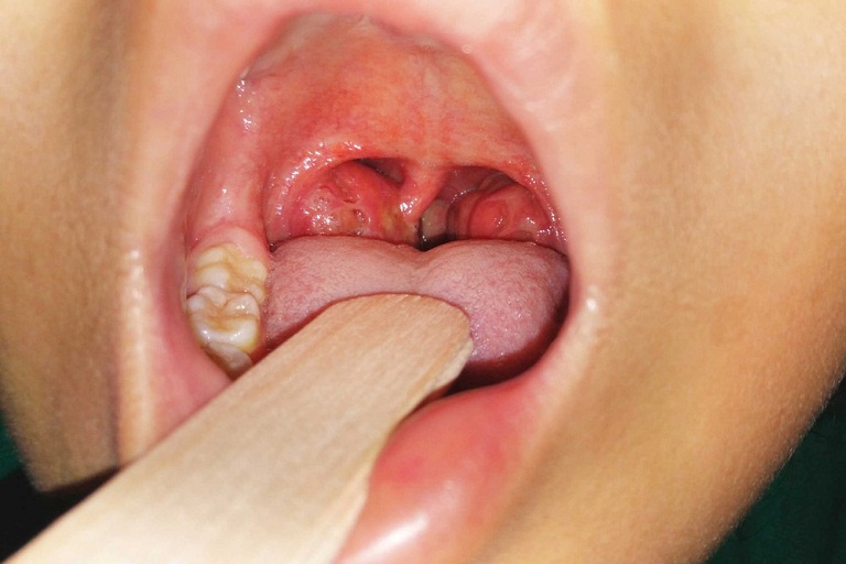 Triệu chứng viêm họng xuất tiết