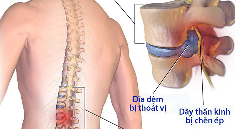 Thoát vị đĩa đệm là nguyên nhân gây đau thắt lưng hông
