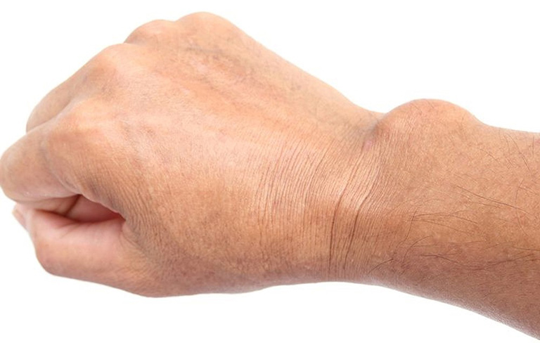  U bao hoạt dịch khớp cổ tay là bệnh gì? Điều trị như thế nào?