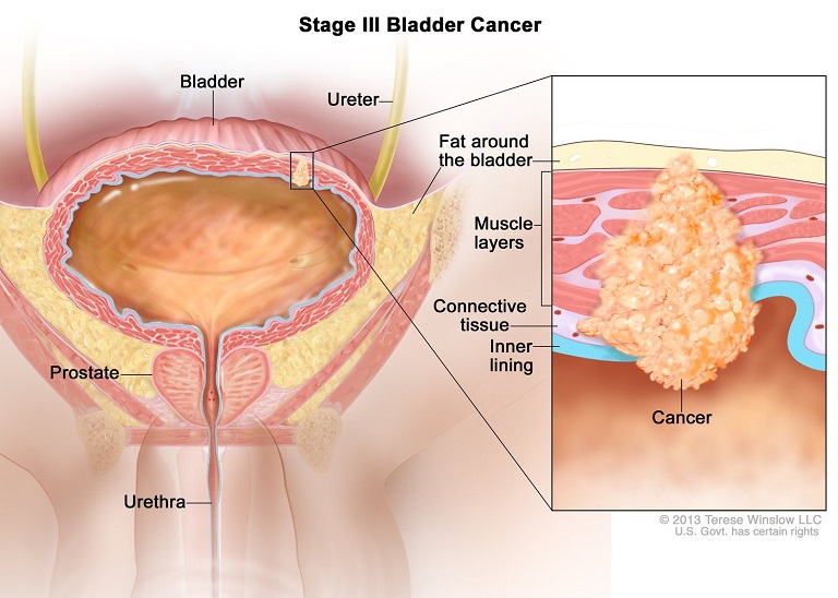 Ung thư bàng quang giai đoạn 3