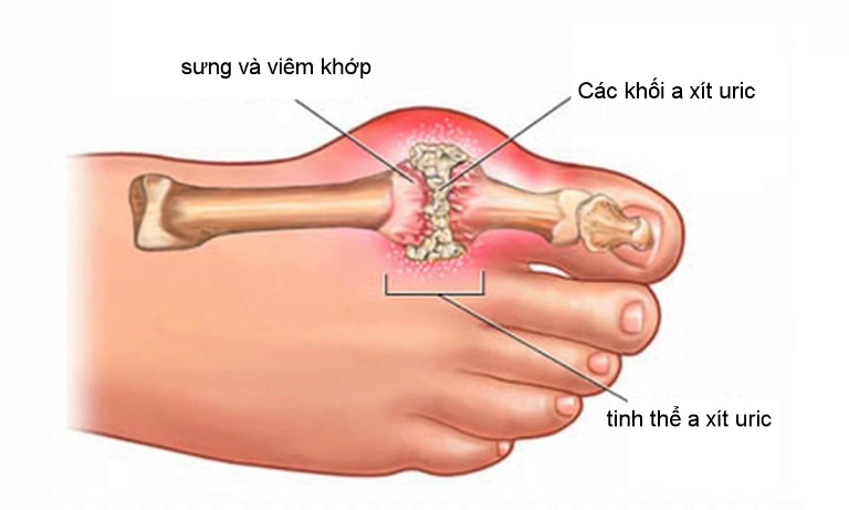 Thuốc Febuday điều trị bệnh gout mãn tính và cấp tính.