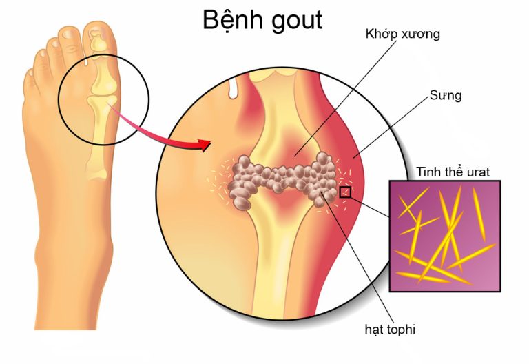 triệu chứng gout cấp tính