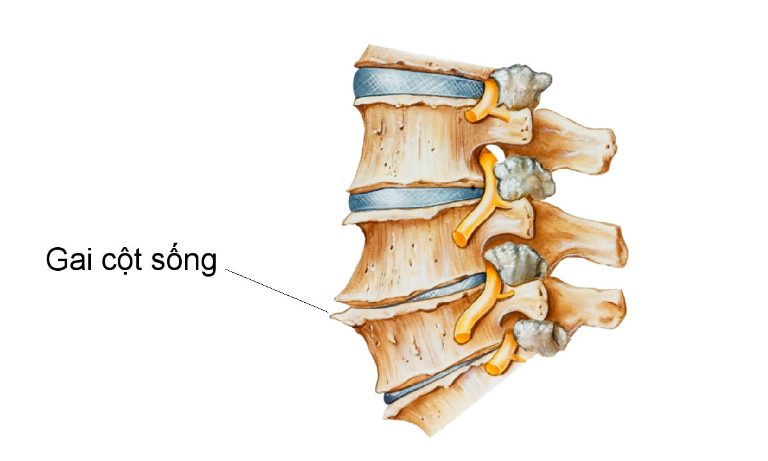 Bệnh gai cột sống gây ra những cơn đau buốt ở thắt lưng. Nguyên nhân là do những gai xương trên đốt sống chèn ép những dây thần kinh.