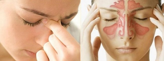 Các biến chứng do viêm mũi dị ứng gồm polyp mũi, viêm xoang, nhiễm trùng tai