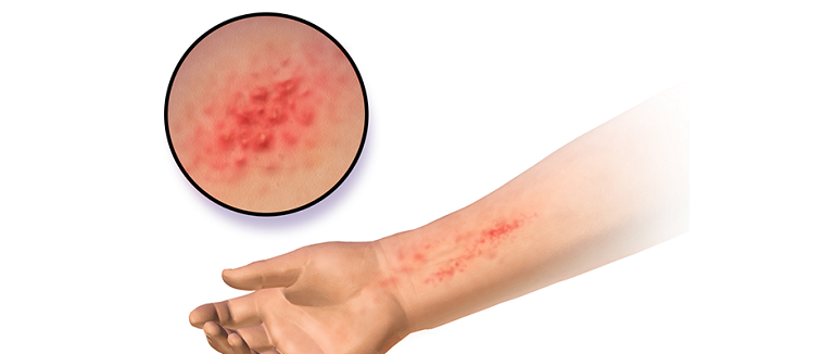 Bệnh chàm tiếp xúc là một loại viêm da do tiếp xúc với chất có hại