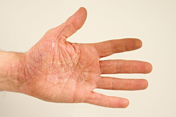 Bệnh tổ đỉa là tình trạng mụn nước xuất hiện ở vùng da lòng bàn tay, lòng bàn chân gây ngứa rát, bong tróc da.