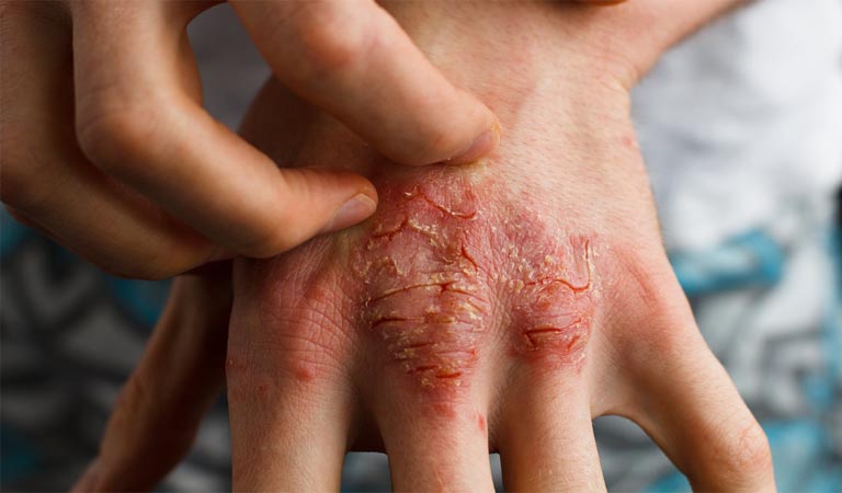 Bệnh eczema có chữa khỏi được không
