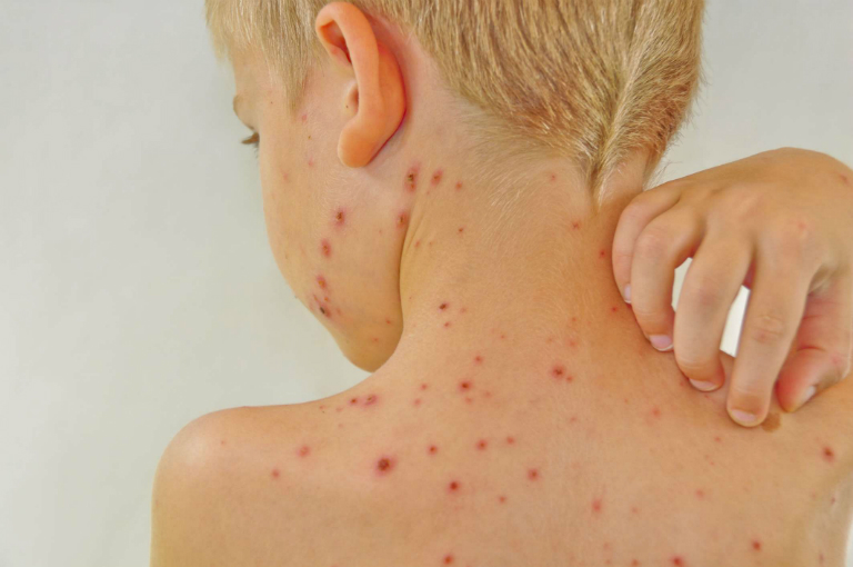 Một số bài thuốc Nam có thể chữa được chứng mẩn ngứa trên da.