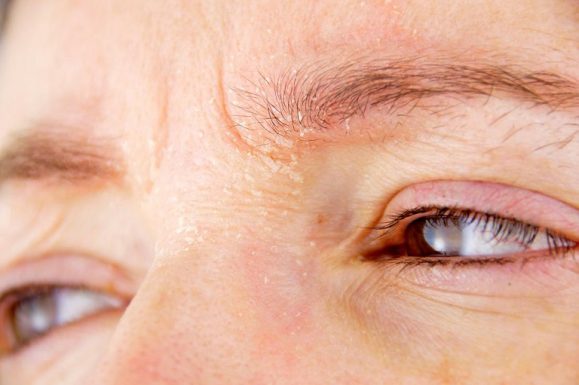 Mẩn ngứa quanh mắt là một trong những biểu hiện của viêm da mí mắt