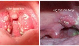 Cách phân biệt viêm họng hạt và ung thư vòm họng