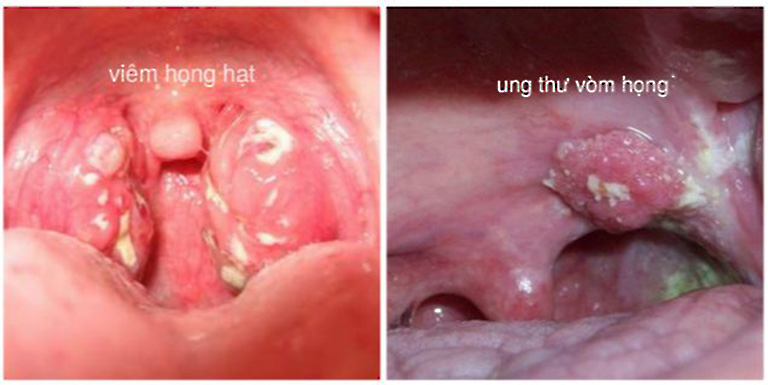 Cách phân biệt viêm họng hạt và ung thư vòm họng 