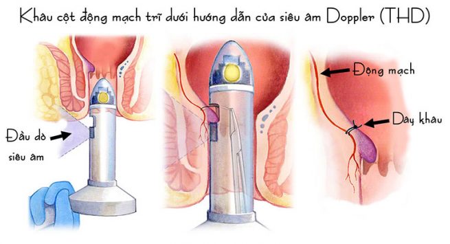 Tìm hiểu phương pháp phẫu thuật chữa trĩ bằng siêu âm Doppler