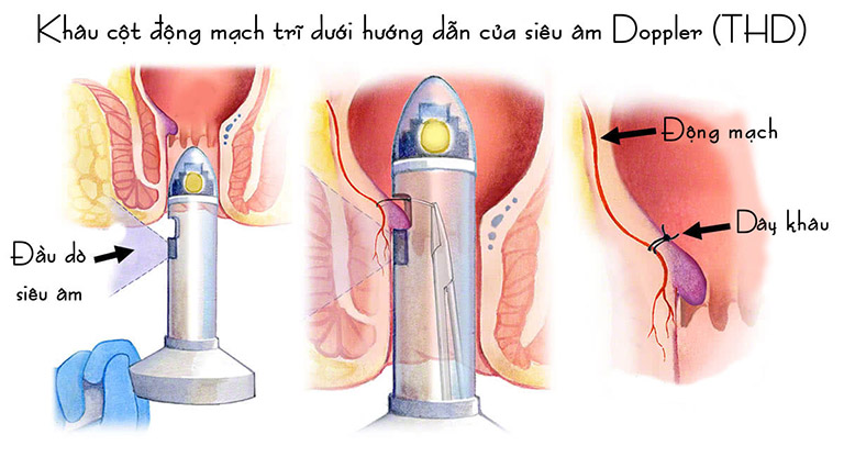 Tìm hiểu phương pháp phẫu thuật chữa trĩ bằng siêu âm Doppler 