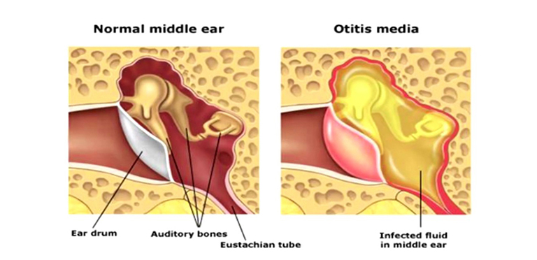viêm tai giữa giai đoạn xung huyết